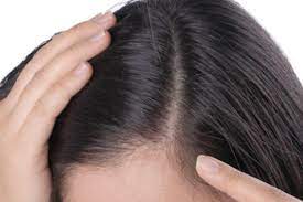 كيفية التعامل مع مرض تساقط الشعر بكفاءة وفعالية
