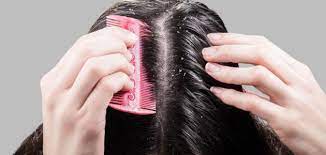 أهمية وتحليلات اللازمة لتساقط الشعر