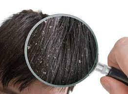 العلاج الطبيعي المثالي لمشكلة تساقط الشعر