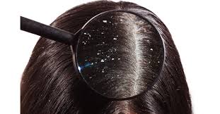 طرق علاج تساقط الشعر عند المرأة المرضعة