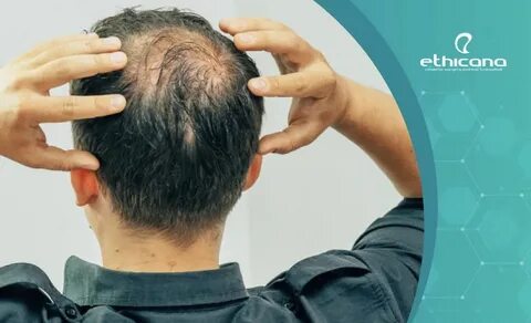 حلول فعالة لتساقط شعر الرجال والنساء